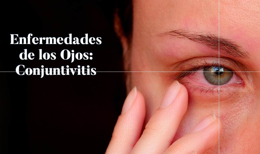 Enfermedades de los Ojos - Conjuntivitis