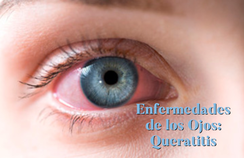 Enfermedades de los Ojos - Queratitis